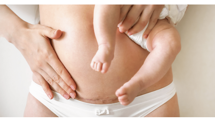 La rééducation périnéale après une césarienne : comment bien récupérer ?